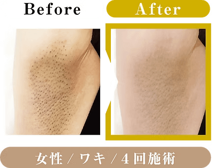 女性・ワキ・４回施術のビフォアアフター