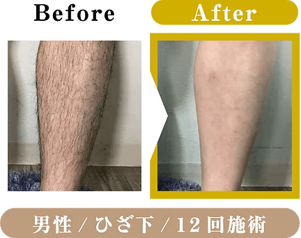 男性・ひざ下・12回施術のビフォアアフター