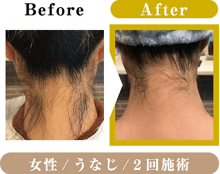 女性・うなじ・2回施術のビフォアアフター