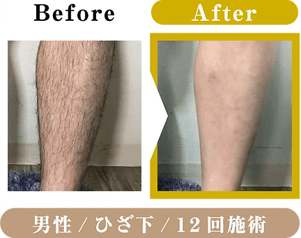 男性・ひざ下・12回施術のビフォアアフター